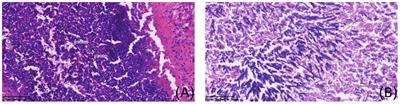 Metagenomic next-generation sequencing could play a pivotal role in validating the diagnosis of invasive mold disease of the central nervous system